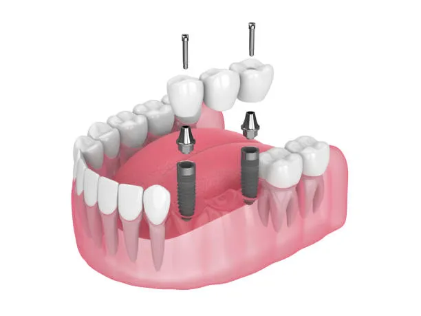Dental crowns & bridges at White Hill Dental in Levittown PA